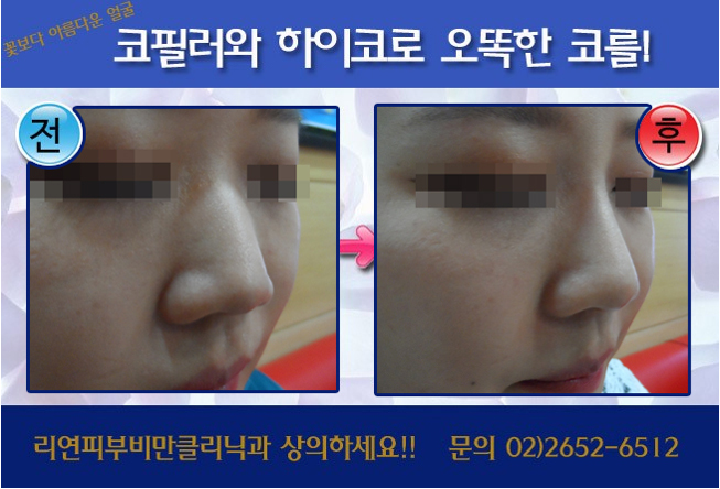 리연클리닉_코필러하이코_전후사진