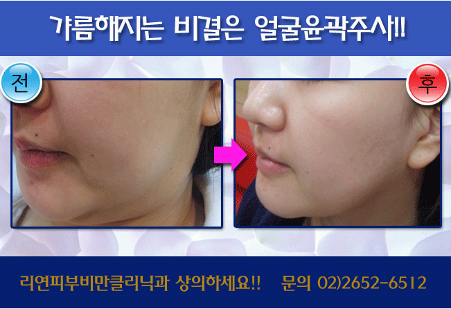 리연클리닉_윤곽주사_시술전후