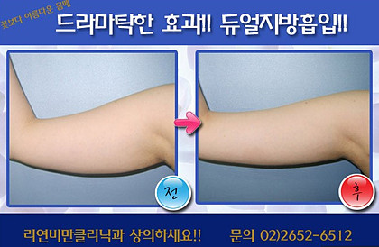 리연클리닉_팔뚝지방흡입_전후사진3