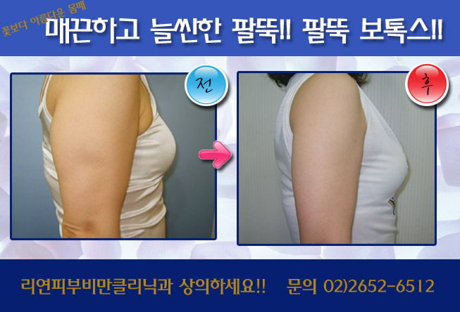리연클리닉_팔뚝보톡스_전후사진3