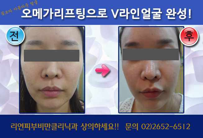 리연클리닉_오메가리프팅_전후사진