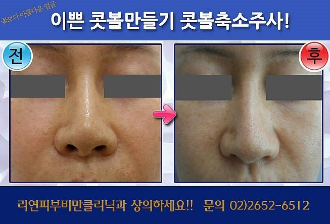 리연클리닉_콧볼주사_전후사진