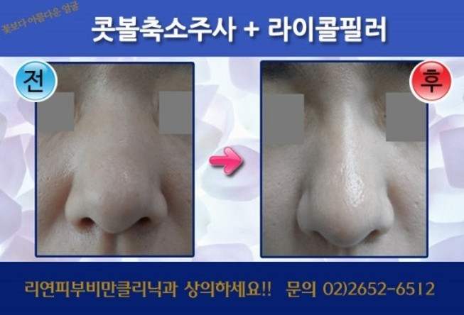 리연클리닉_라이콜콧볼주사_전후사진