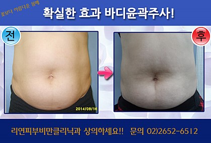 리연클리닉_바디윤곽주사_전후사진5