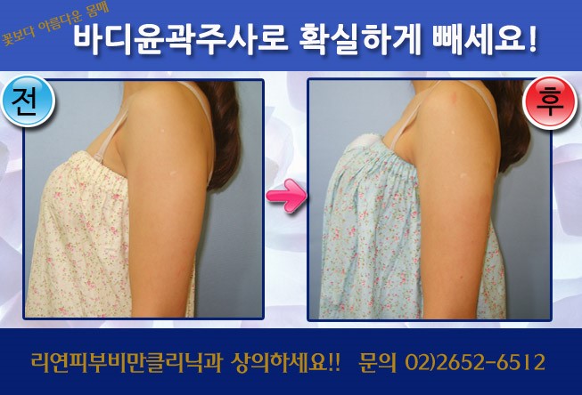 리연클리닉_바디윤곽주사_전후사진4