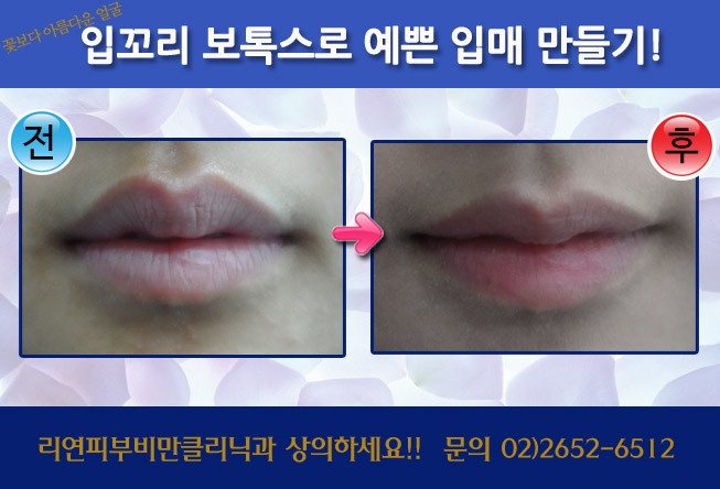 리연클리닉_입꼬리보톡스_전후사진2