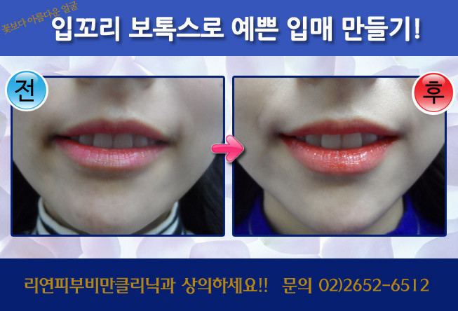 리연클리닉_입꼬리보톡스_전후사진3