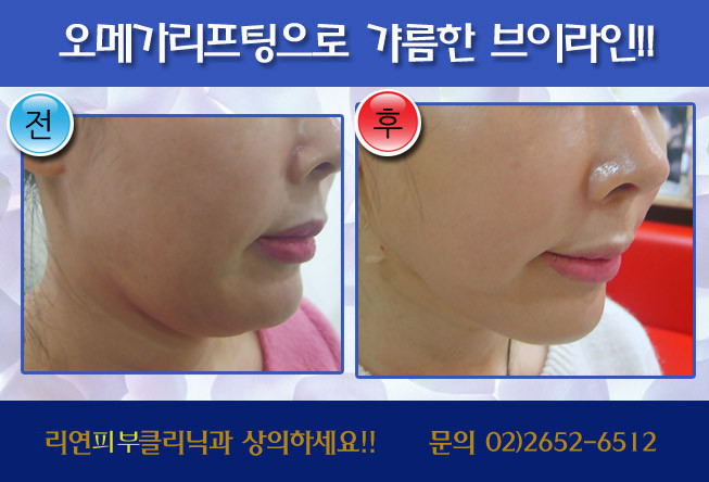 오메가리프팅시술전후수정