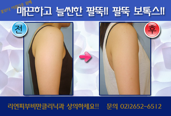 리연클리닉 바디보톡스