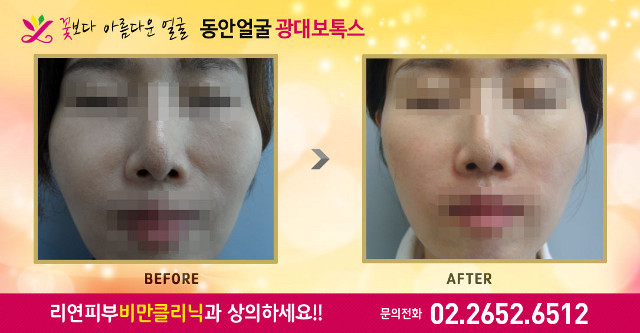 리연클리닉 광대보톡스 전후사진