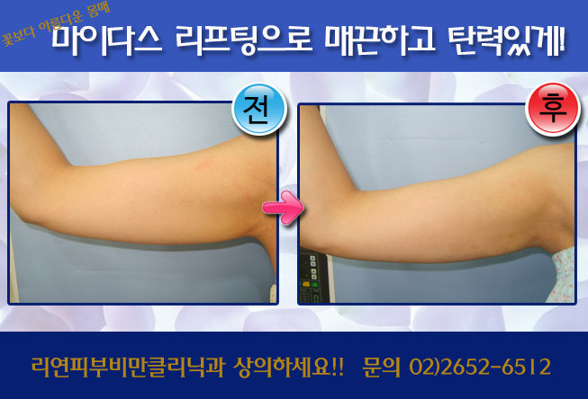 리연클리닉_팔뚝리프팅_전후사진