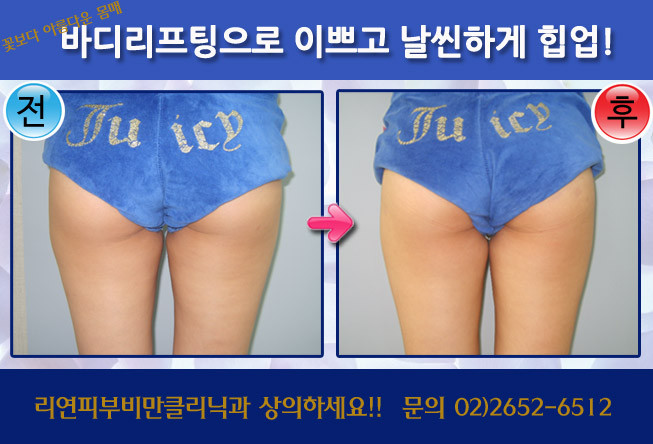 리연클리닉_바디리프팅_전후사진