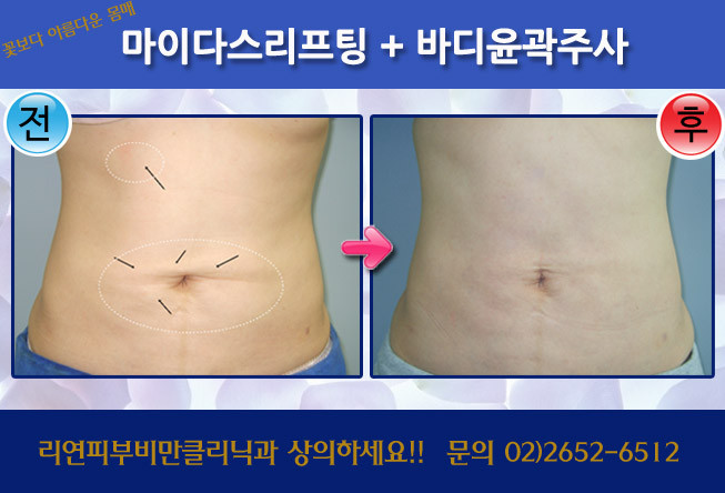리연클리닉_바디리프팅윤곽주사_전후사진