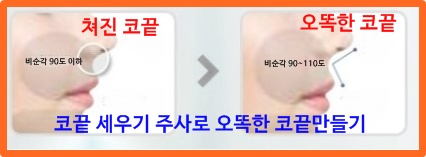 코끝세우기주사_비순각교정
