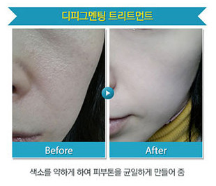 리연클리닉_밀크필_시술안내_전후사진2