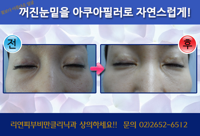 리연클리닉_아쿠아필러_전후사진2