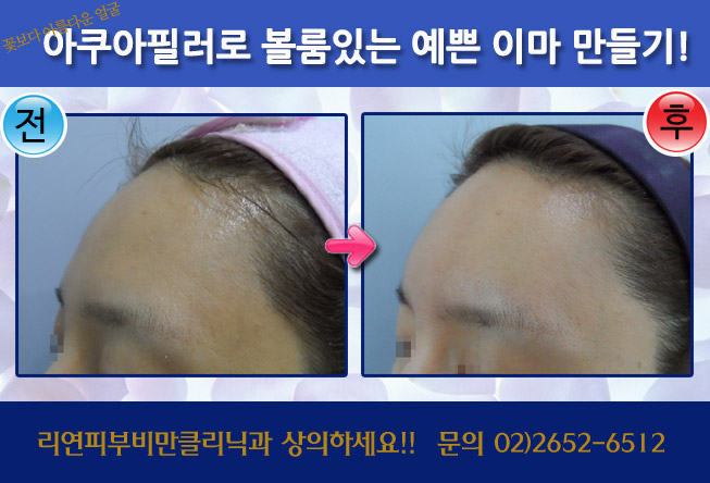 리연클리닉_아쿠아이마필러_전후사진