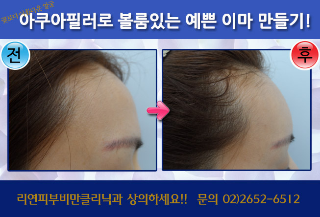 리연클리닉_아쿠아필러_이마필러_전후사진_150420