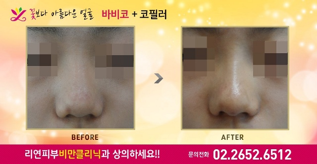 리연클리닉 바비코성형 전후사진