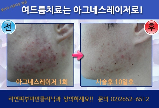 리연클리닉_아그네스레이저여드름치료_전후사진_150431