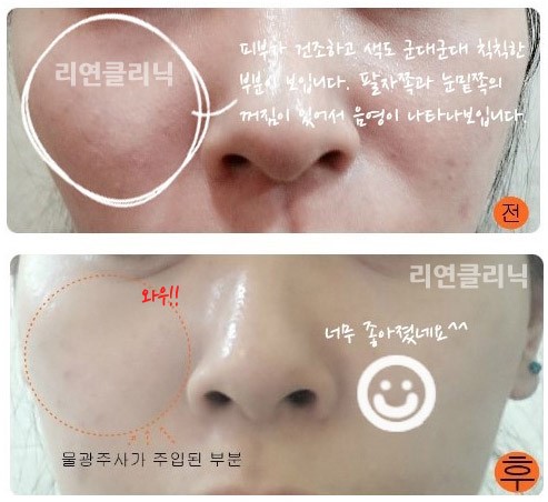 리연클리닉_물광주사_시술전후