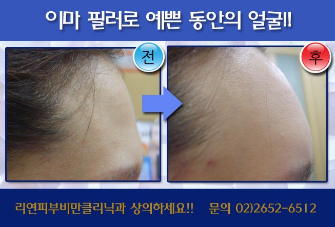 리연클리닉 필러 전후사진