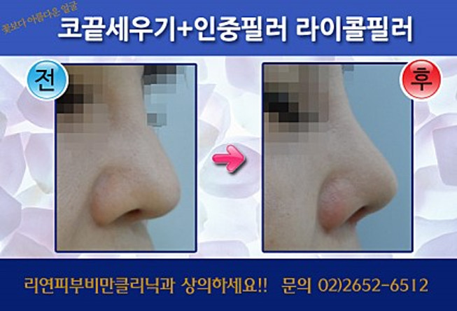 리연클리닉 필러 전후사진
