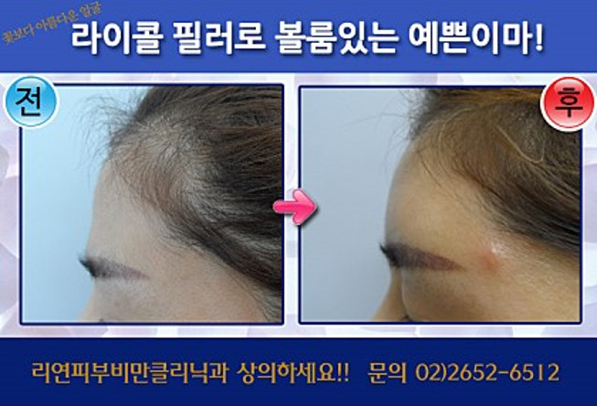 리연클리닉 라이콜필러 전후사진