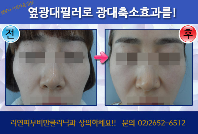 리연클리닉 필러 전후사진