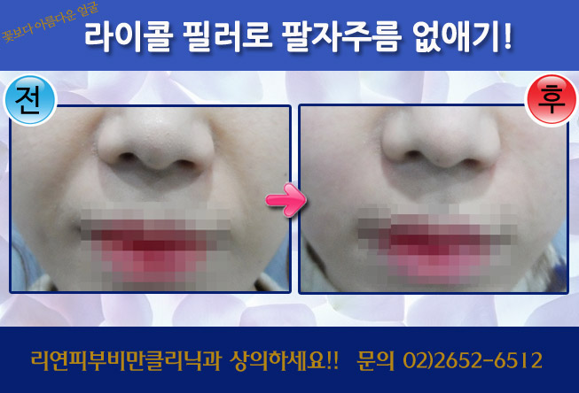 리연클리닉 필러 전후사진