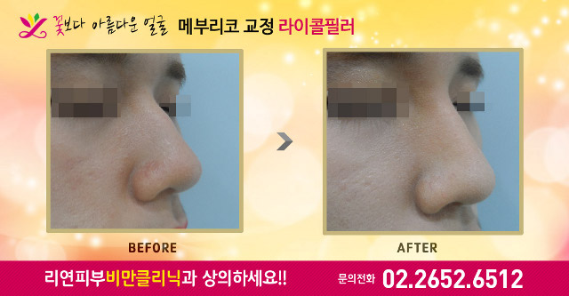 리연클리닉 라이콜 메부리코필러 전후사진